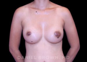 Breast Augmentation - Case 2224 - After
