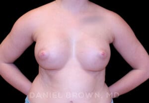 Breast Augmentation - Case 2231 - After