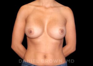 Breast Augmentation - Case 2242 - After