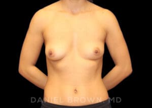 Breast Augmentation - Case 2242 - Before