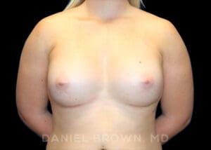 Breast Augmentation - Case 2267 - After