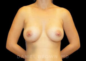 Breast Augmentation - Case 2274 - After