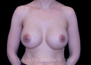 Breast Augmentation - Case 2295 - After