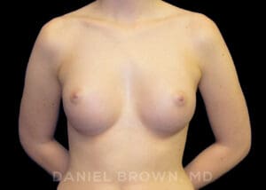Breast Augmentation - Case 2302 - After