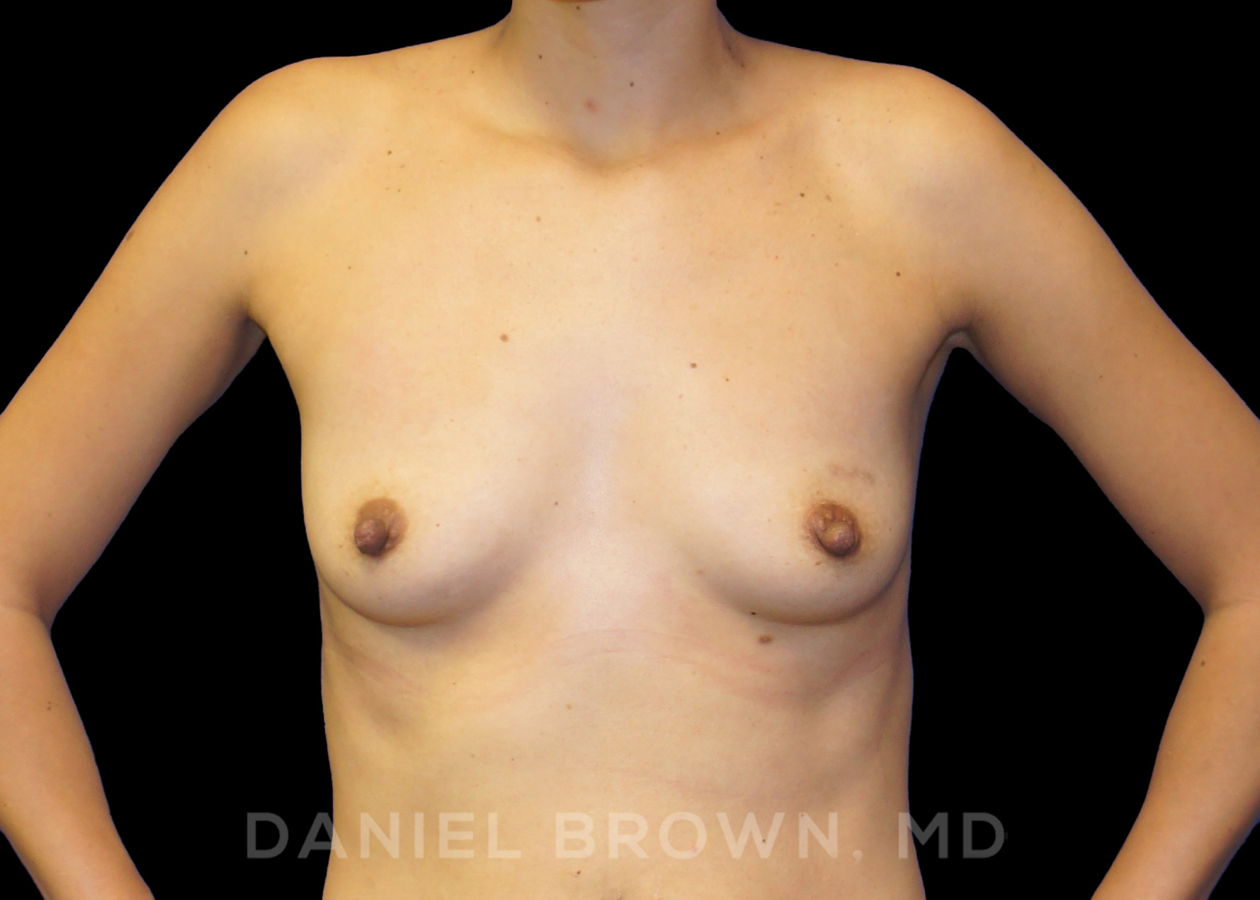Breast Augmentation Patient Photo - Case 2320 - before view-0