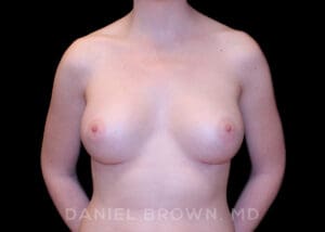 Breast Augmentation - Case 2338 - After