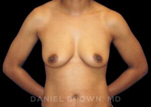 Breast Augmentation - Case 2349 - Before