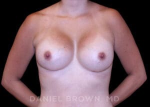 Breast Augmentation - Case 2374 - After