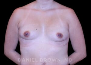 Breast Augmentation - Case 2374 - Before