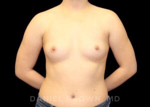 Breast Augmentation - Case 2385 - Before
