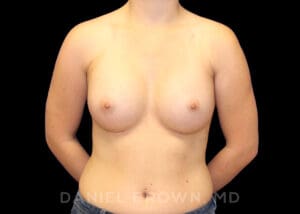 Breast Augmentation - Case 2385 - After