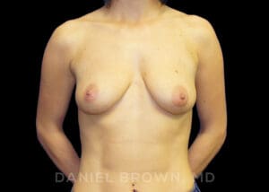 Breast Augmentation - Case 2403 - Before