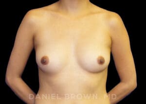 Breast Augmentation - Case 2410 - Before