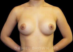 Breast Augmentation - Case 2431 - After