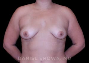 Breast Augmentation - Case 2438 - Before