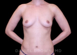 Breast Augmentation - Case 2445 - Before