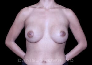 Breast Augmentation - Case 2456 - After