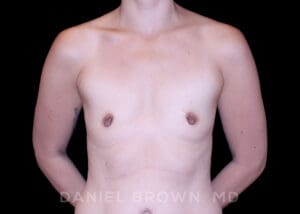 Breast Augmentation - Case 2467 - Before