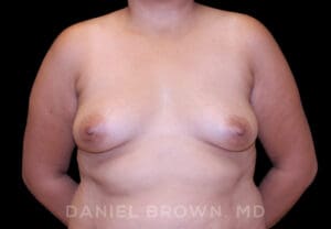 Breast Augmentation - Case 2500 - Before