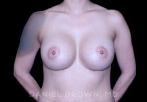 Breast Augmentation - Case 2522 - After
