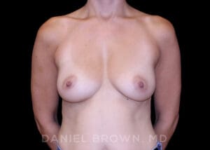 Breast Augmentation - Case 2533 - Before