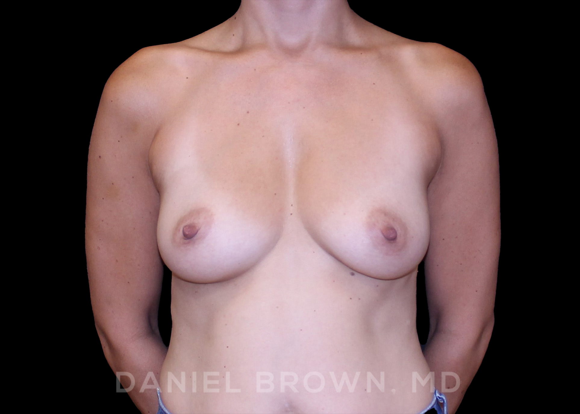 Breast Augmentation, Daniel Brown M.D