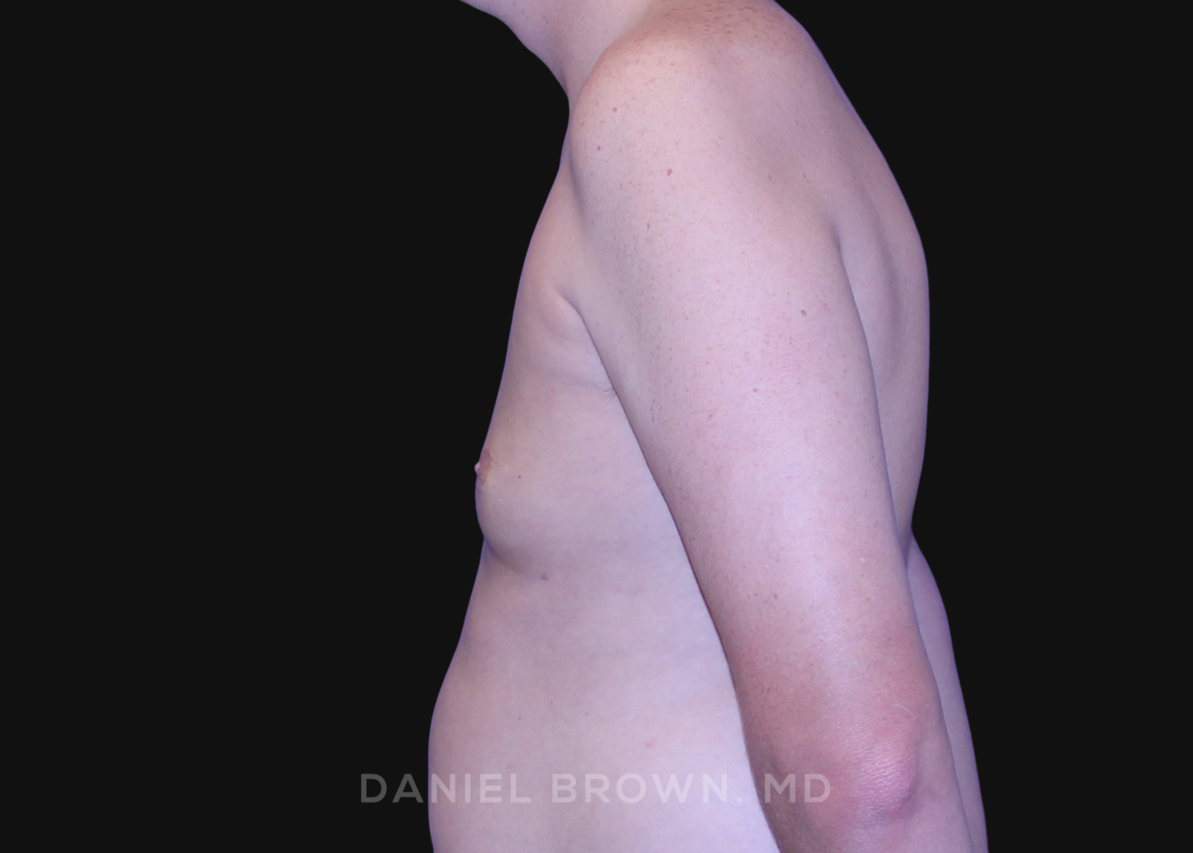 Gynecomastia Patient Photo - Case 2591 - after view-3