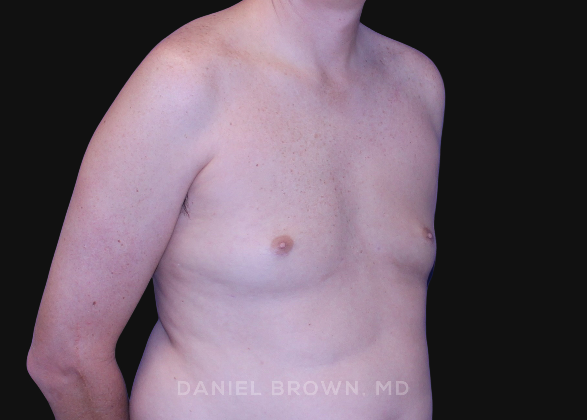 Gynecomastia Patient Photo - Case 2591 - after view-2