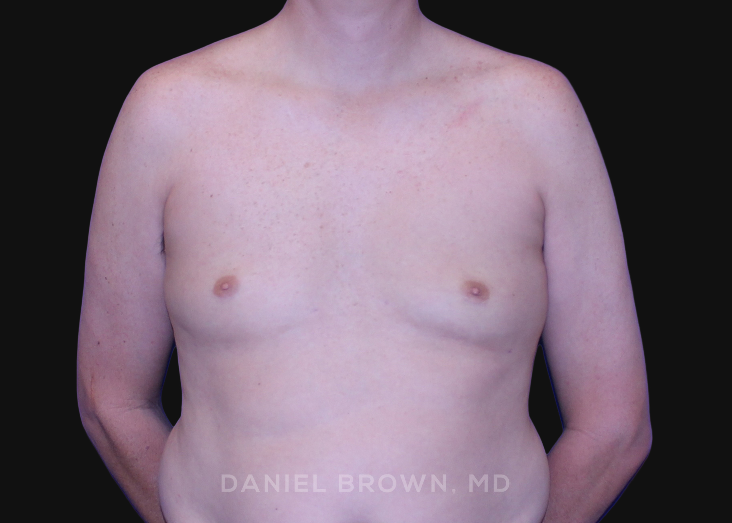Gynecomastia Patient Photo - Case 2591 - after view-0