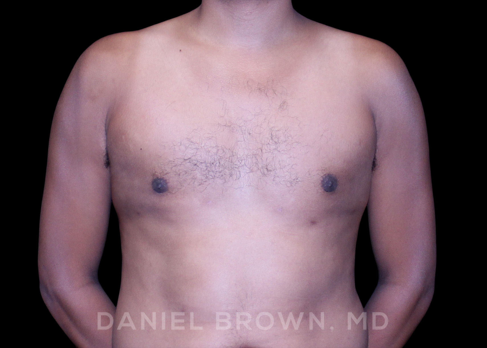 Gynecomastia Patient Photo - Case 2636 - after view-0