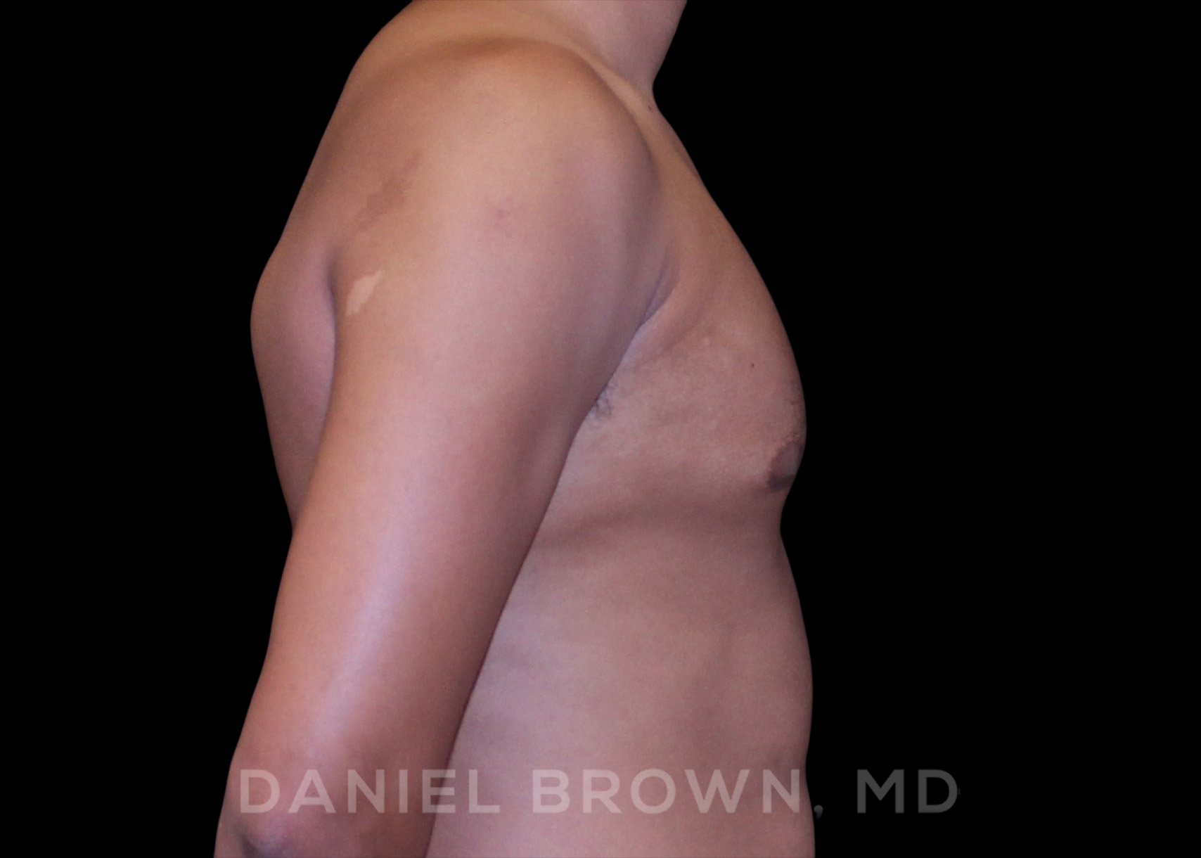 Gynecomastia Patient Photo - Case 2636 - before view-