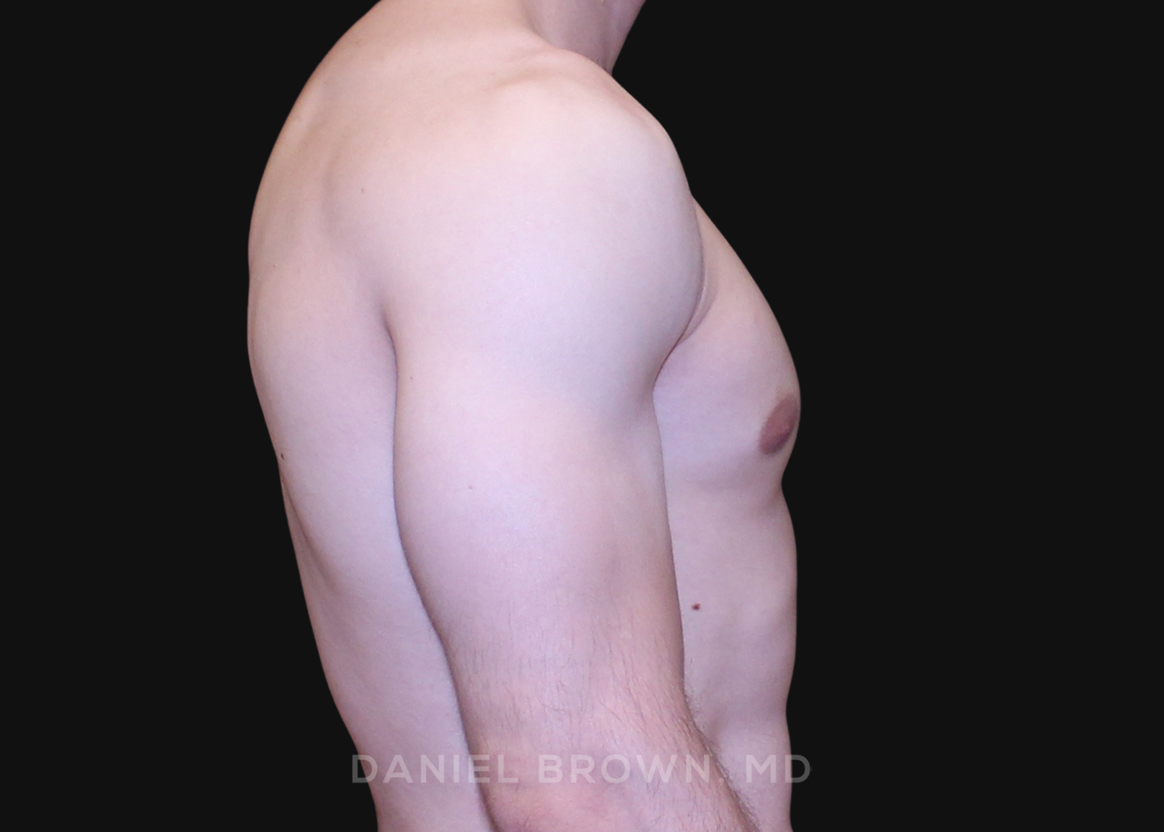 Gynecomastia Patient Photo - Case 2691 - after view-4