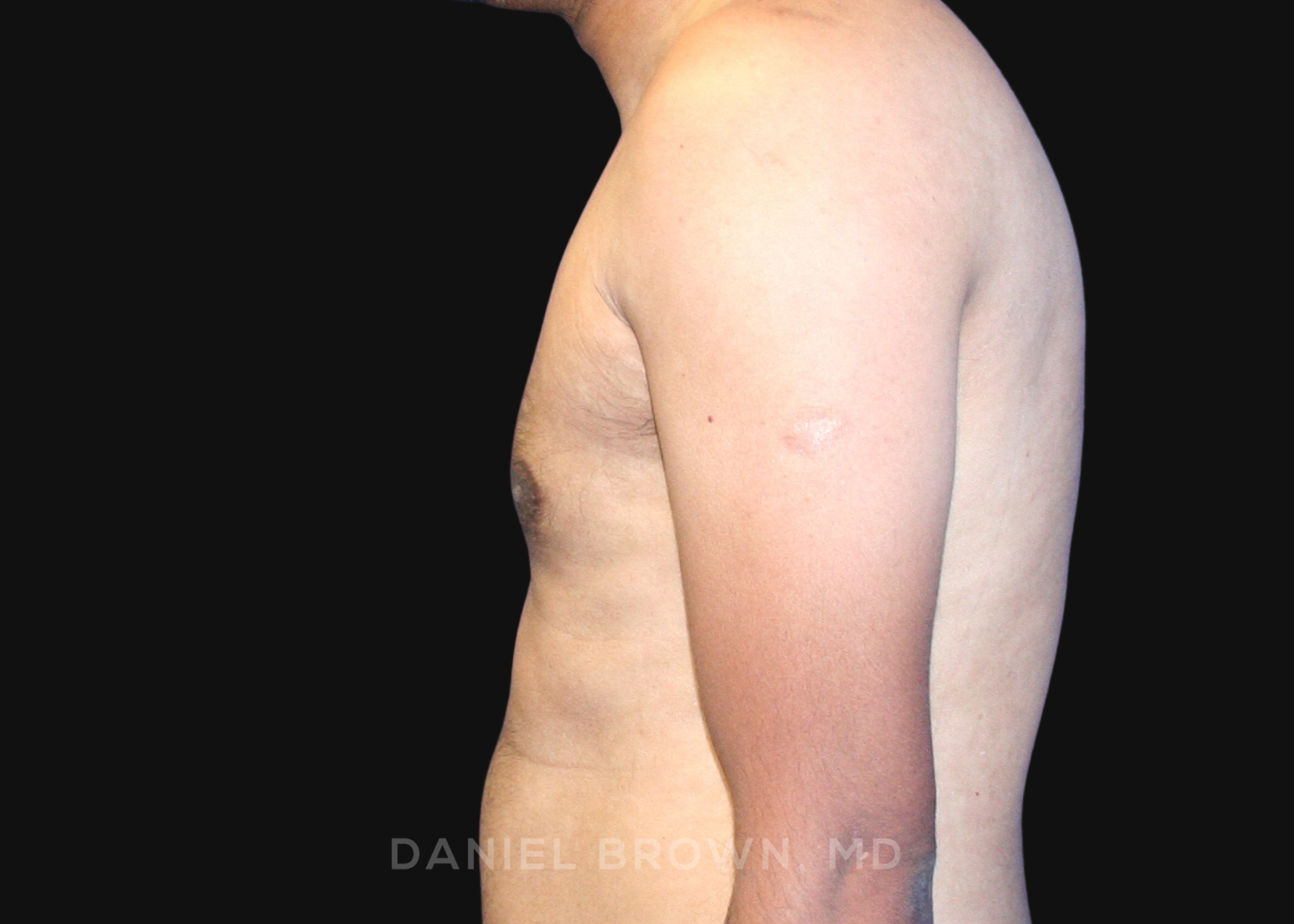 Gynecomastia Patient Photo - Case 2713 - after view