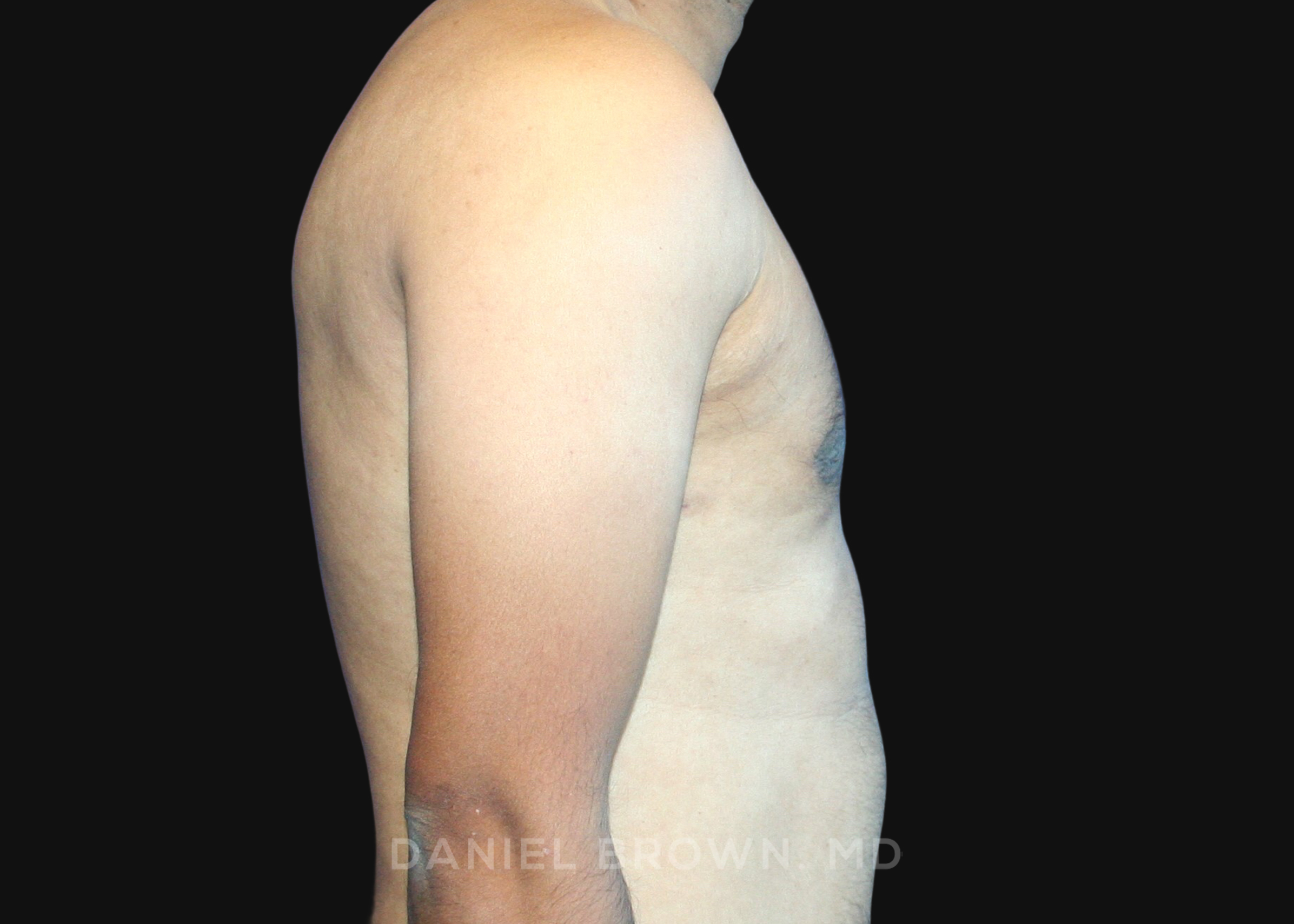 Gynecomastia Patient Photo - Case 2713 - after view
