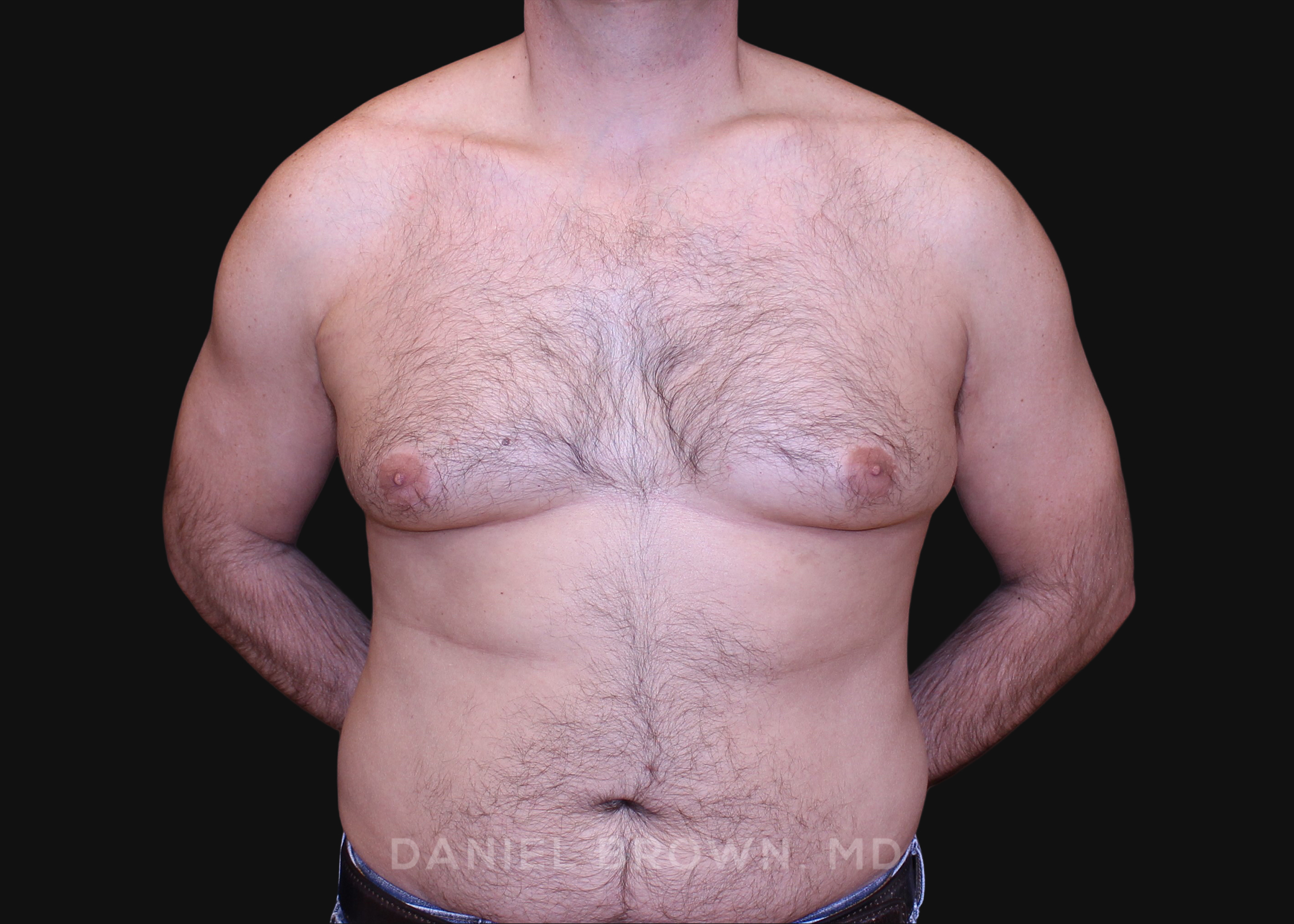 Male Breast Reduction Surgery, Daniel Brown M.D