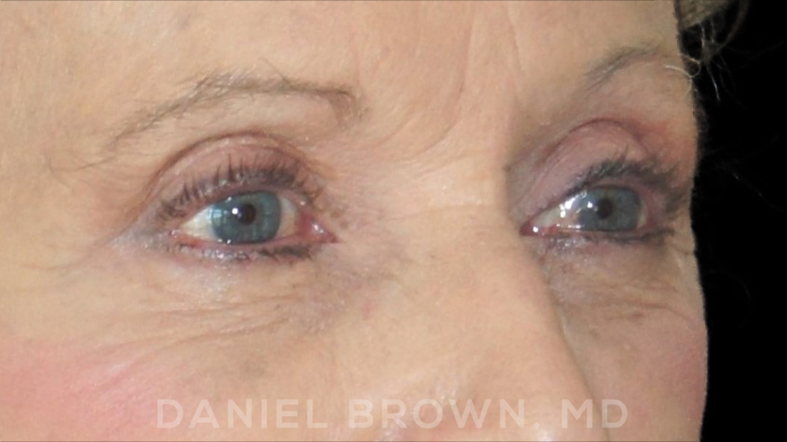 Blepharoplasty Patient Photo - Case 957 - after view-9