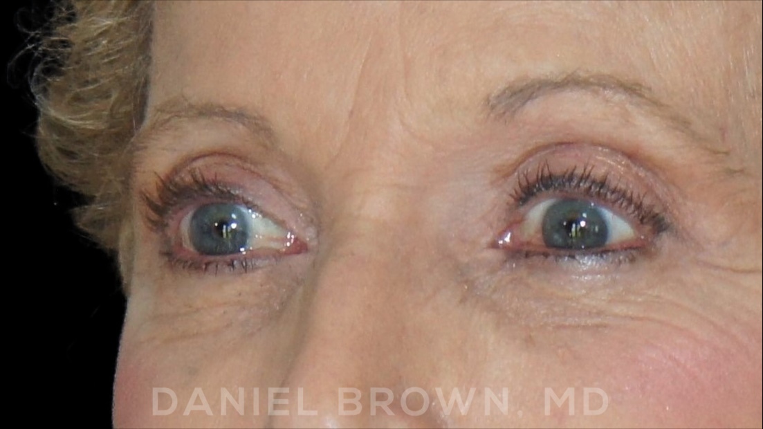 Blepharoplasty Patient Photo - Case 957 - after view-2