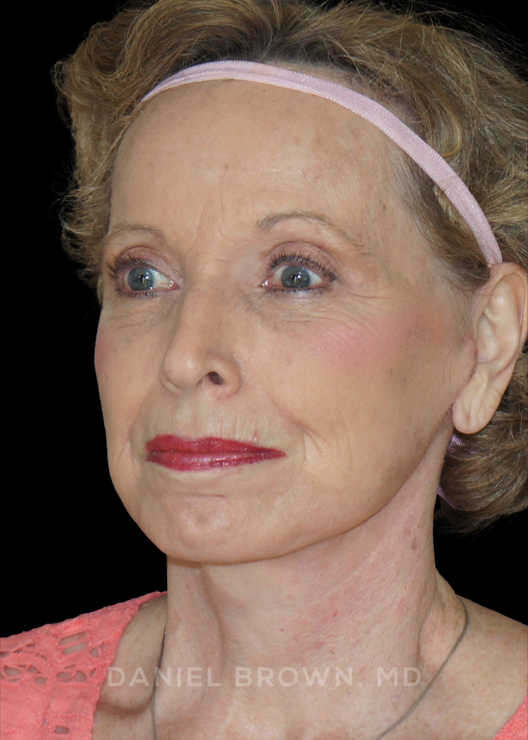 Blepharoplasty Patient Photo - Case 957 - after view-3