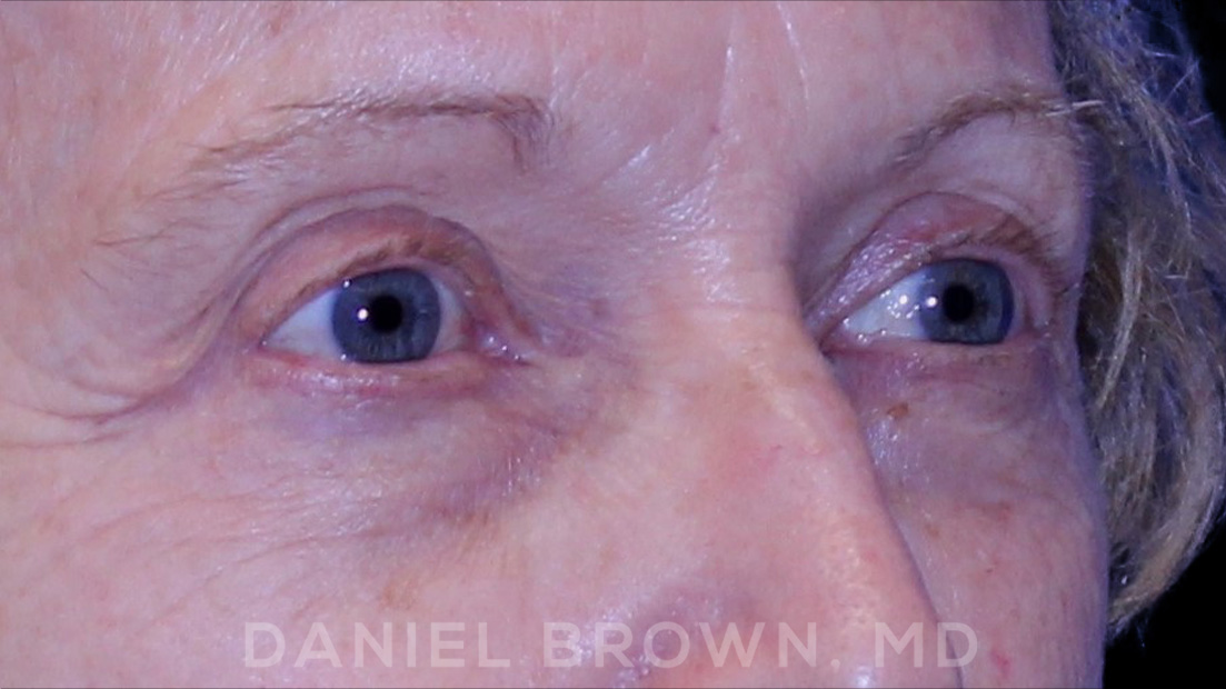 Blepharoplasty Patient Photo - Case 957 - before view-9