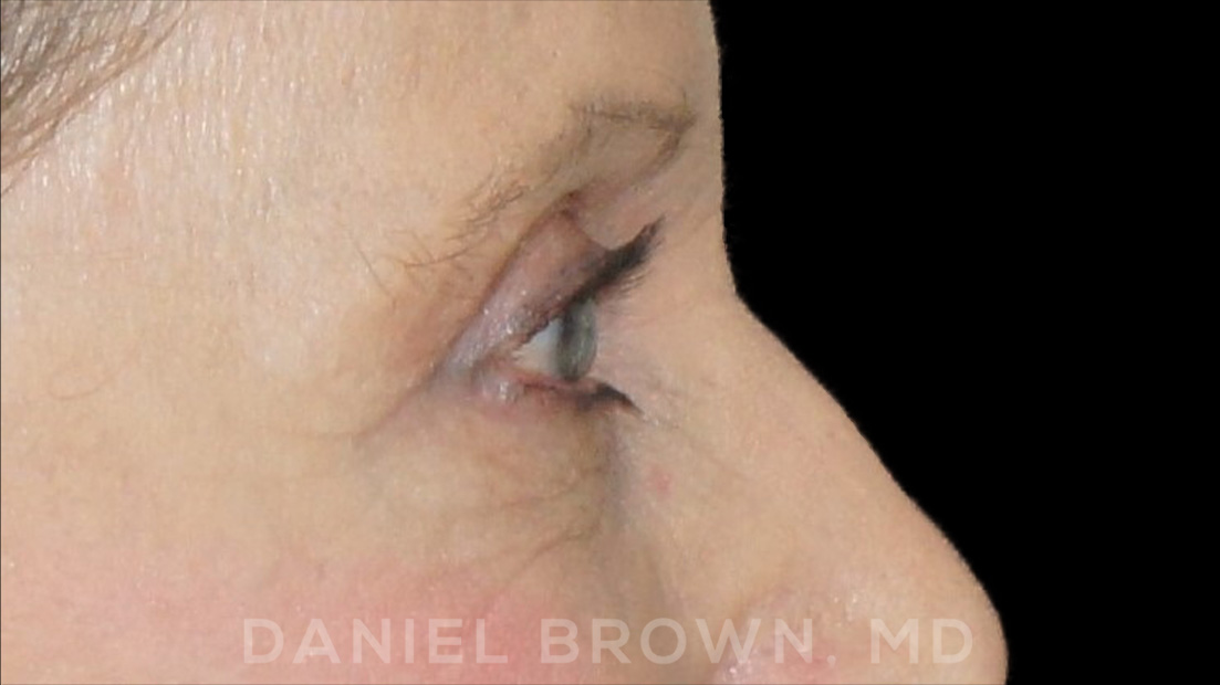Blepharoplasty Patient Photo - Case 957 - after view-7