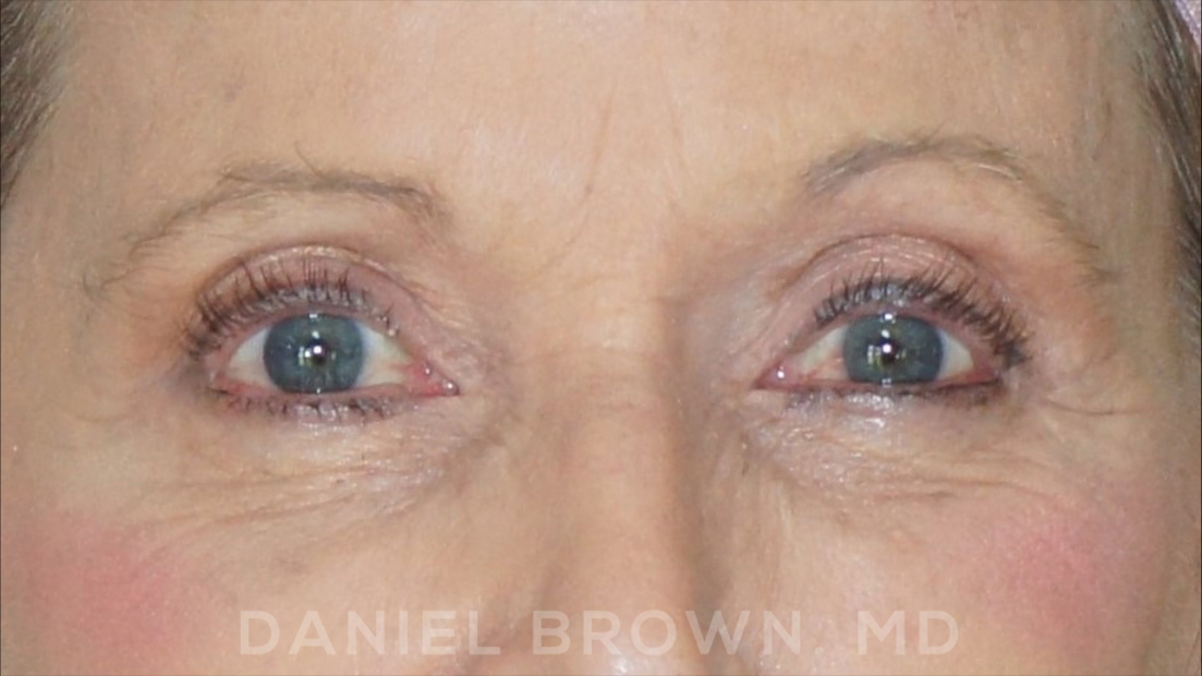 Blepharoplasty Patient Photo - Case 957 - after view-1