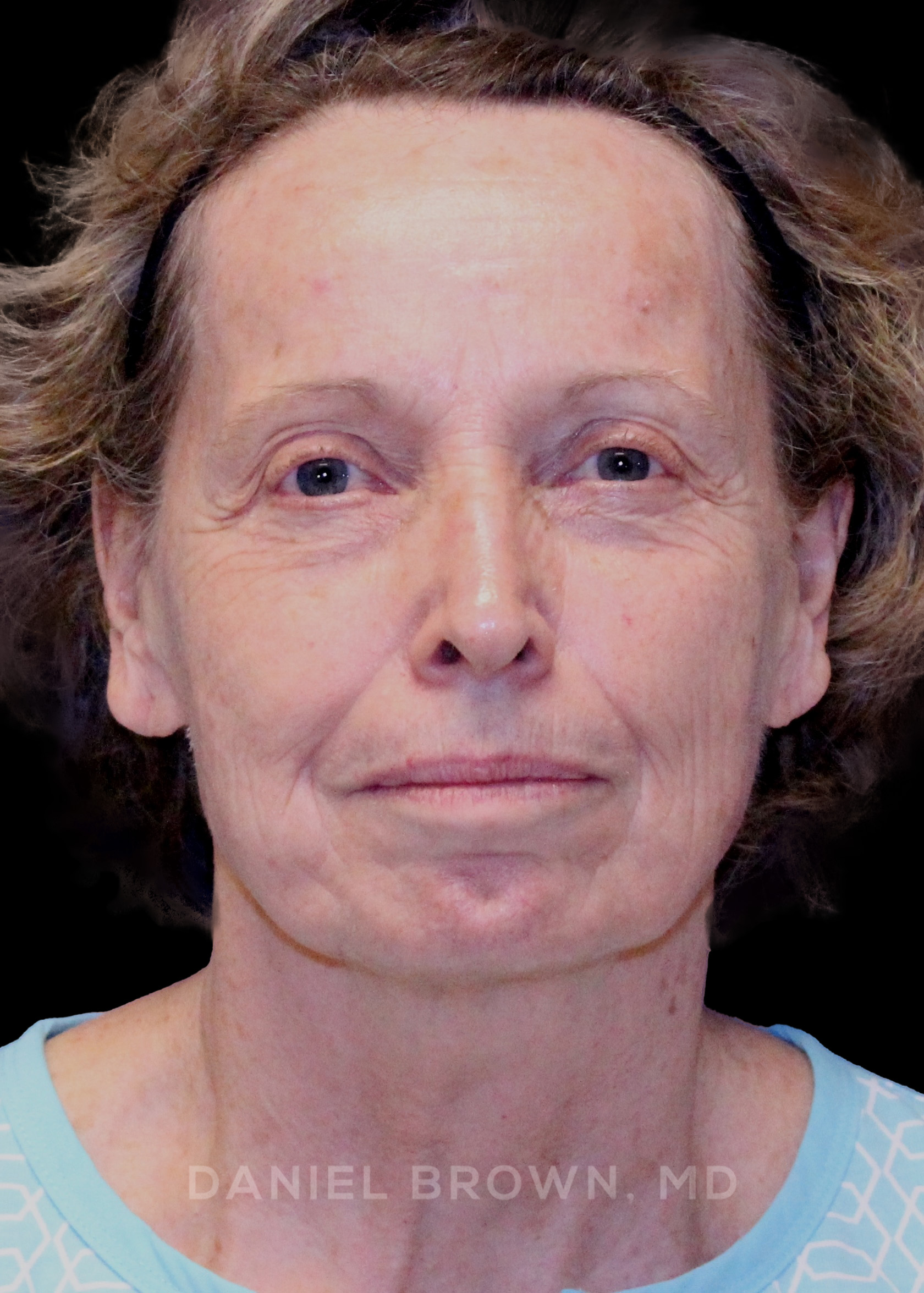 Blepharoplasty Patient Photo - Case 957 - before view-0