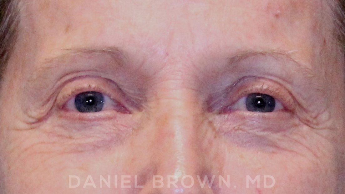 Blepharoplasty Patient Photo - Case 957 - before view-1