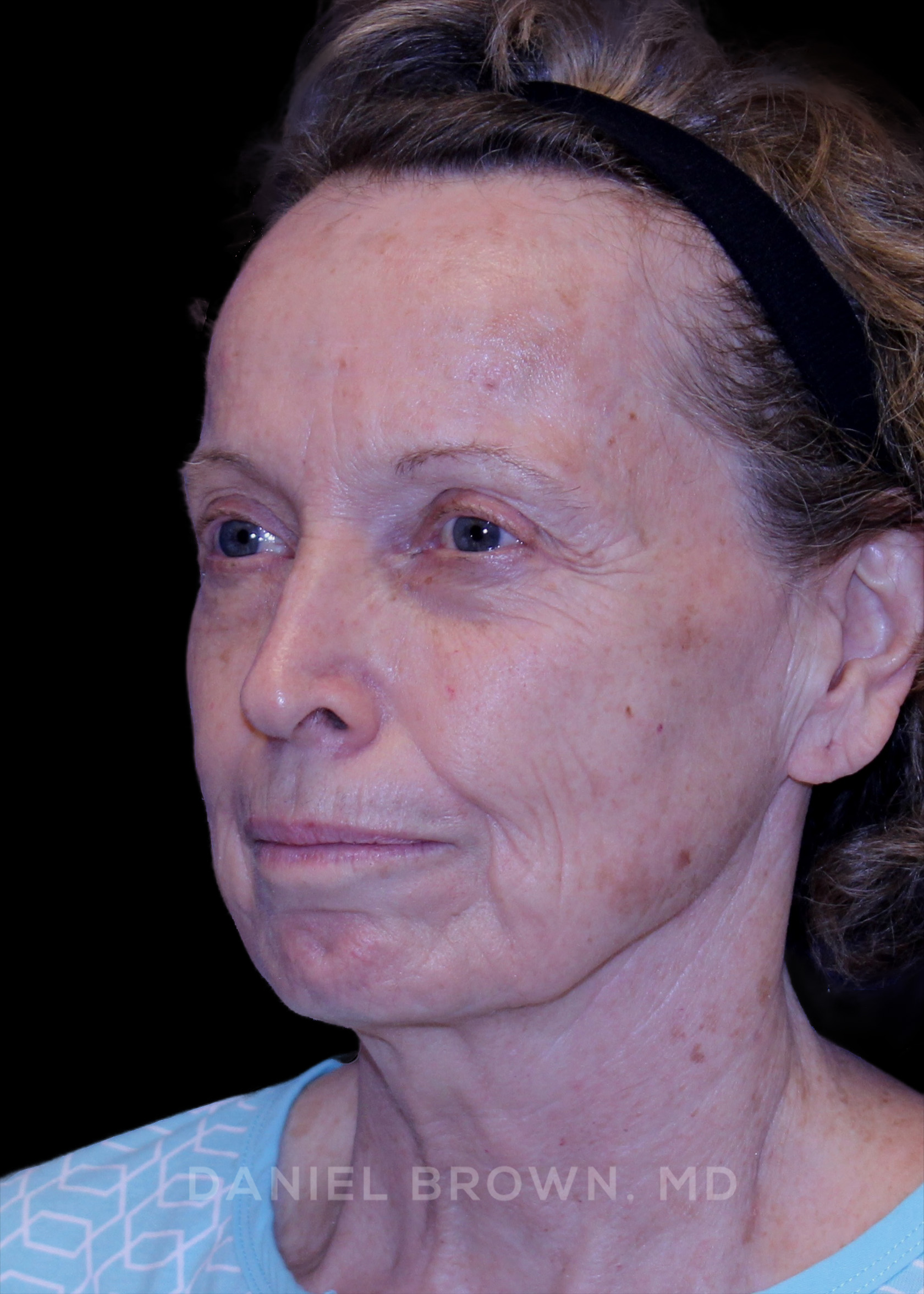 Blepharoplasty Patient Photo - Case 957 - before view-