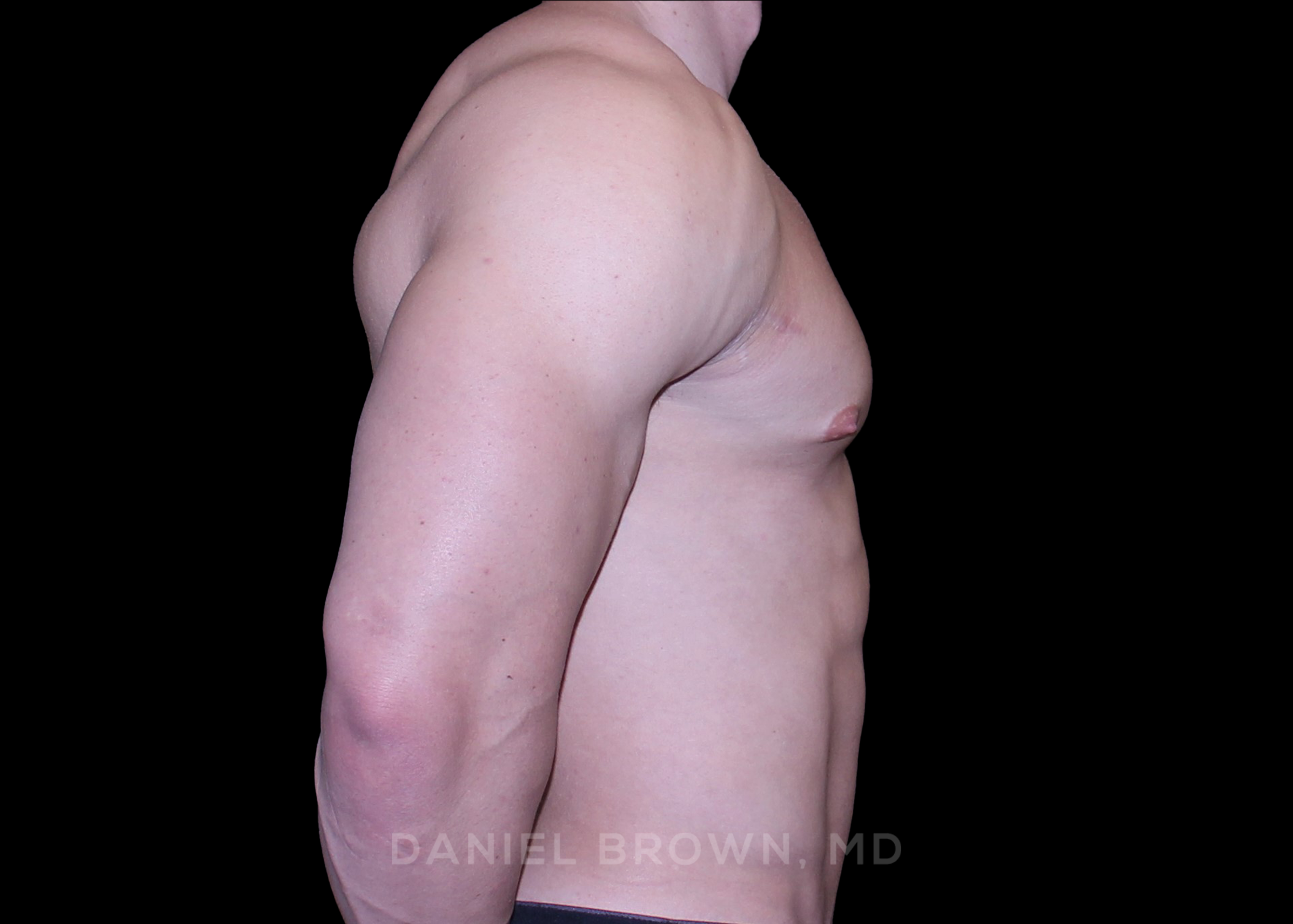 Gynecomastia Patient Photo - Case 3916 - before view-3