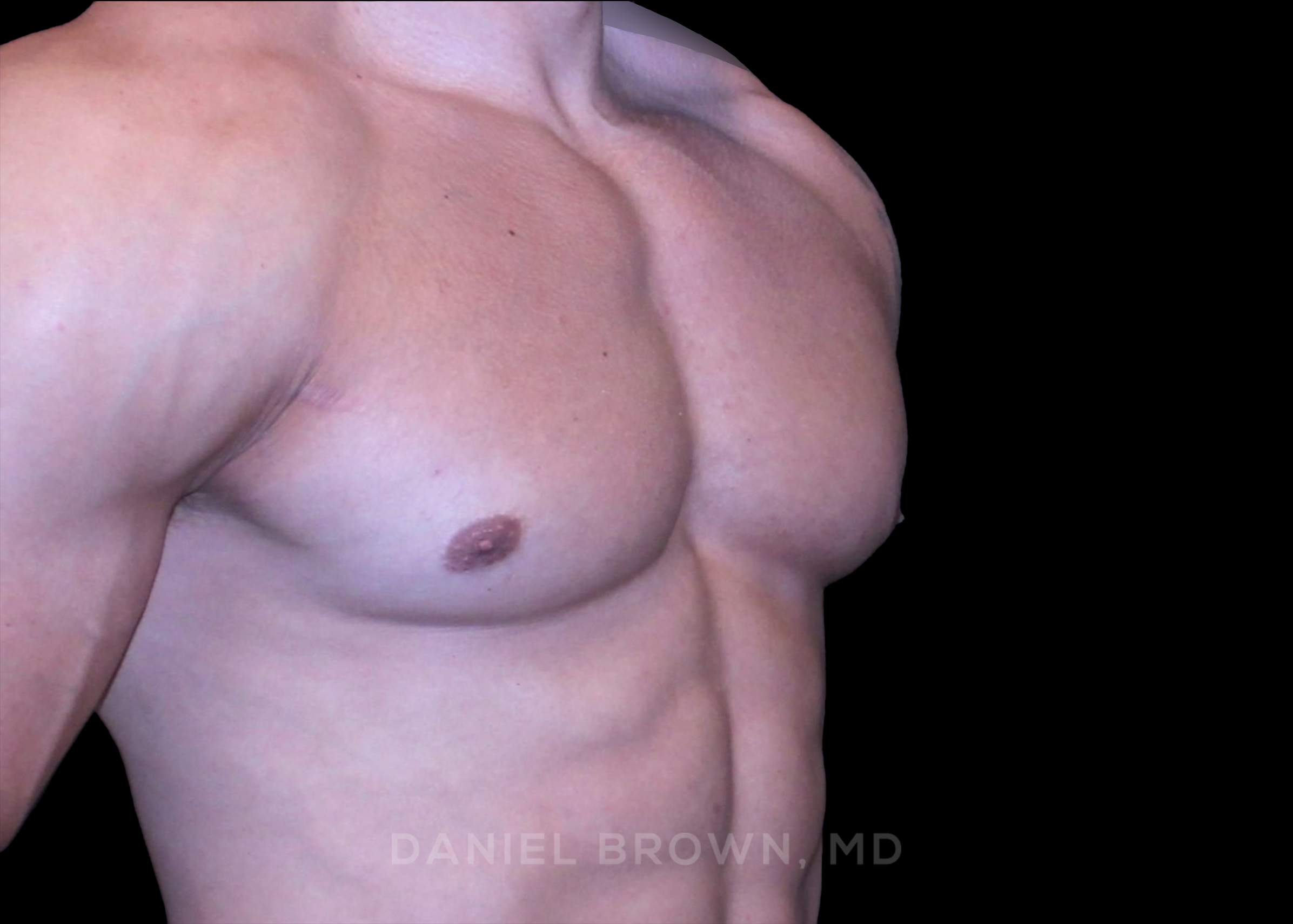 Gynecomastia Patient Photo - Case 3916 - after view