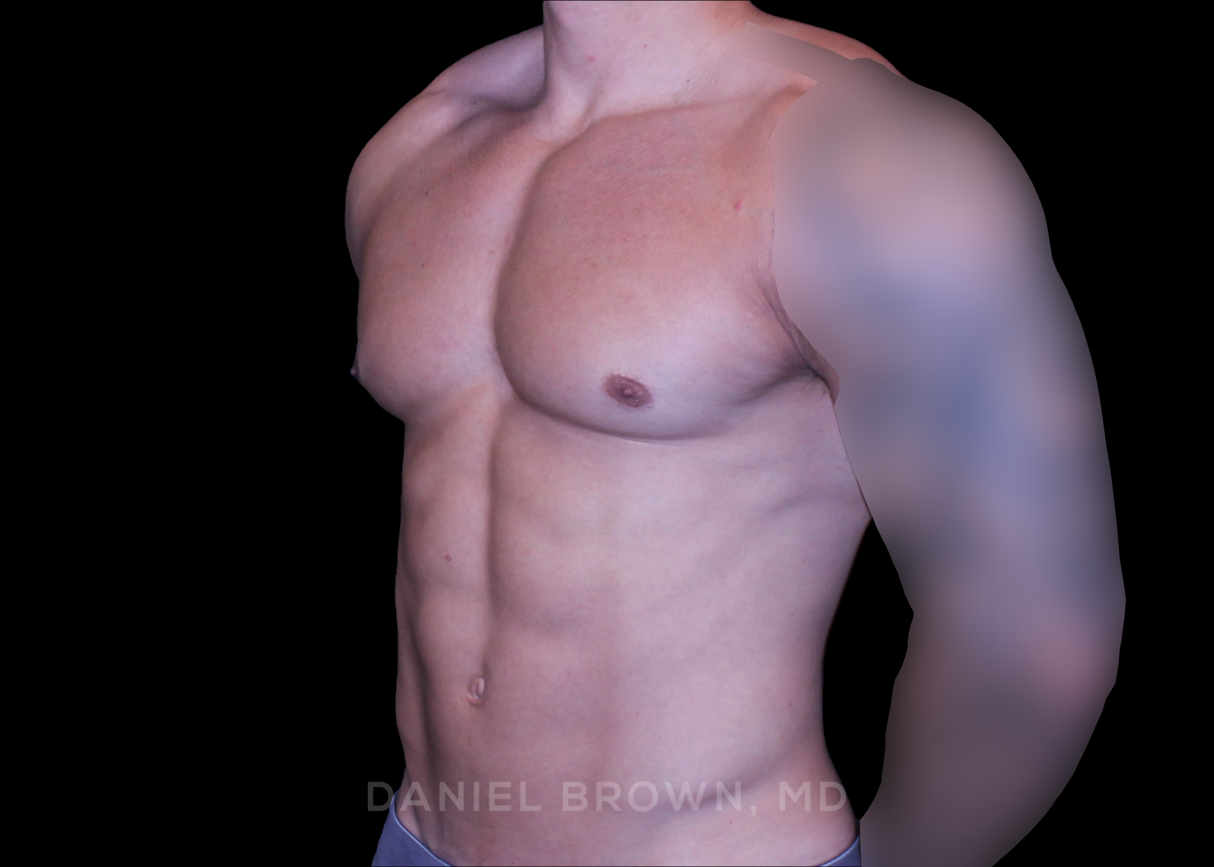 Gynecomastia Patient Photo - Case 3916 - after view