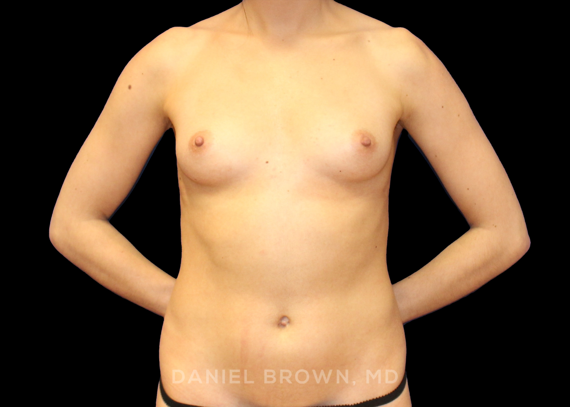 Breast Augmentation - Case 4230 - Before