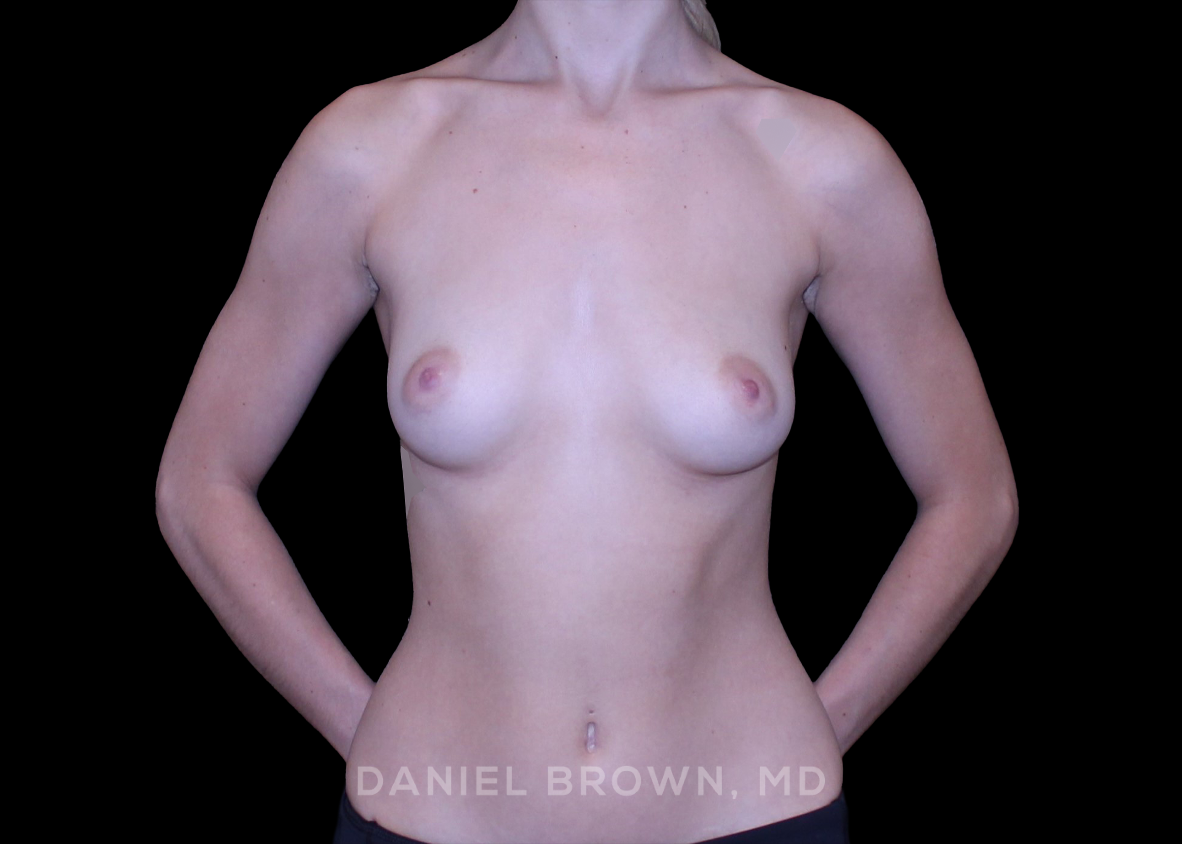 Breast Augmentation - Case 4263 - Before