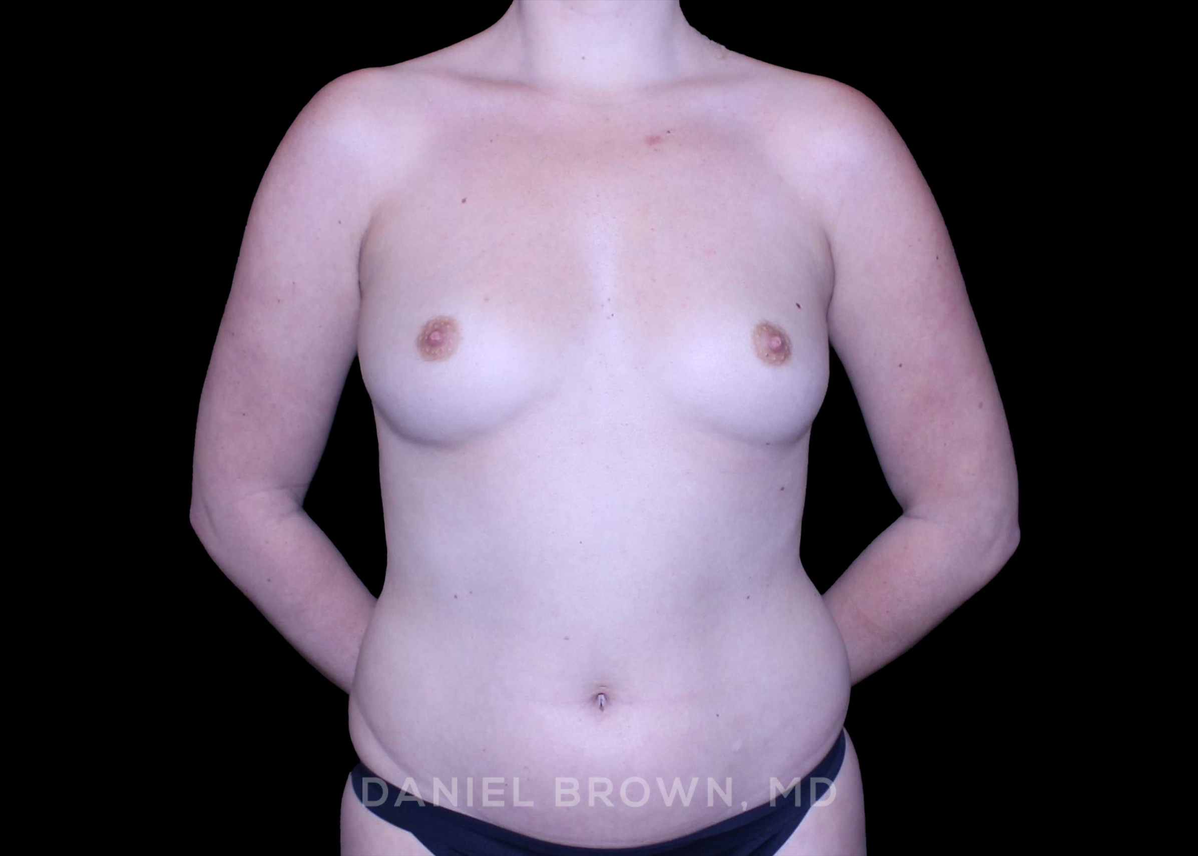 Breast Augmentation - Case 4329 - Before